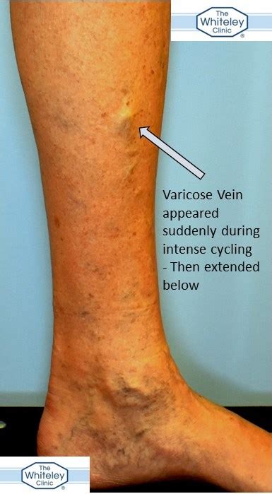 Can Cycling Cause Varicose Veins The Whiteley Clinic