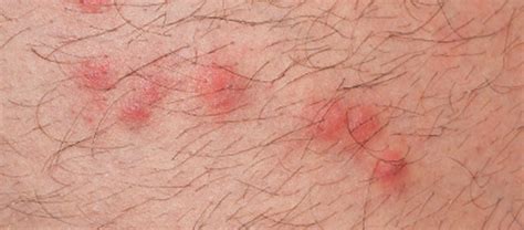 Flea Bites Vs Bed Bug Bites On Humans