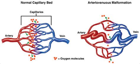 Arterio Venous Malformations Memphis Vascular Center