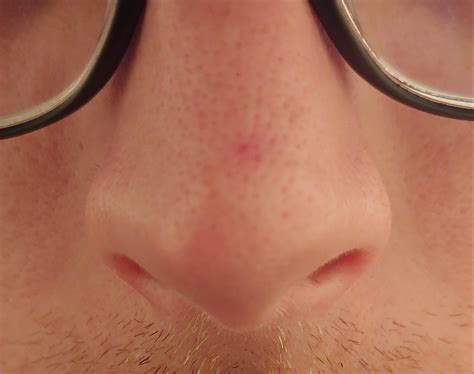 So Ive Had This Thing On My Nose For At Least A Few Weeks I Know Its