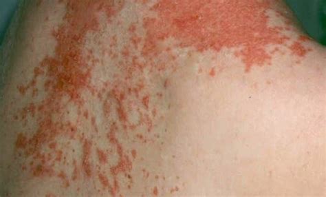 Maculopapular Rash Pictures Causes Treatment Definition Signs