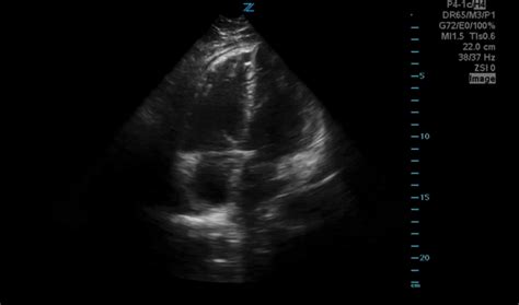 Pulmonary Embolism Archives Ucsd Ultrasound