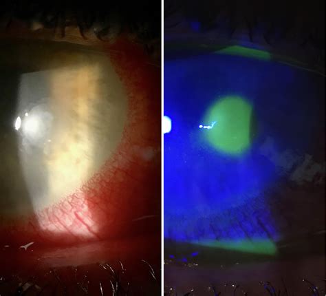 Corneal Ulcer Secondary To Contact Lens Abuse Roptometry