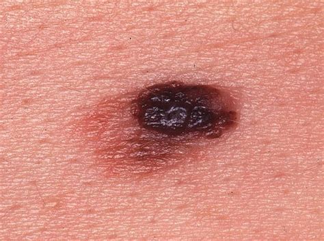 Genetic Tests Show How Sunlight Turns Moles Into Melanoma Nbc News
