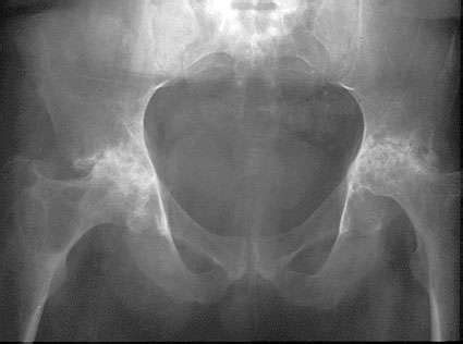 Rheumatoid arthritis is an inflammatory arthritis affecting both small and large joints in a symmetric distribution. Radiological Hip with Rheumatoid Arthritis | Arthritis ...