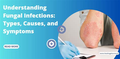 Understanding Fungal Infections Types Causes And Symptoms Healing