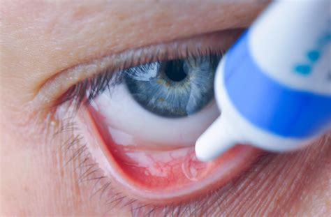 How To Apply Eye Ointment For Dry Eye Mydryeye