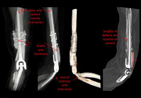 Challenging Elbow Revisions Total Elbow Arthroplasty With Massive Bone