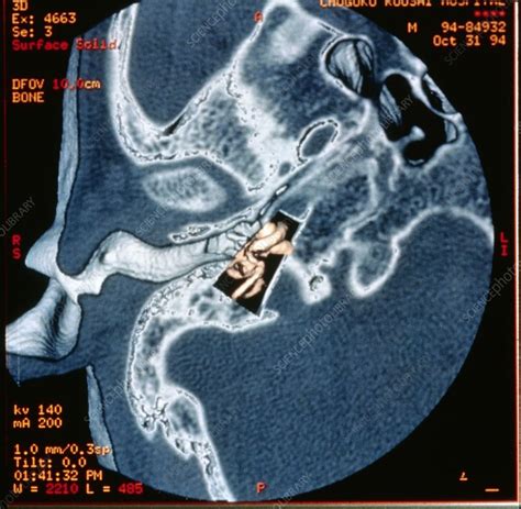 Middle Ear Anatomy Ct