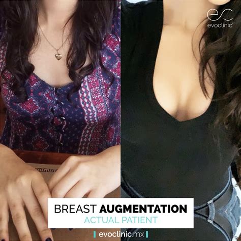 Aumento de senos Antes y después del procedimiento evoclinic
