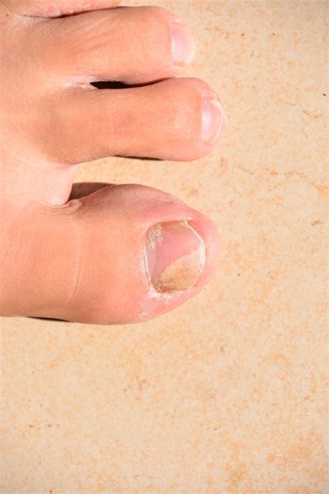 How To Tell If You Have A Toenail Fungus Colorado Center Of