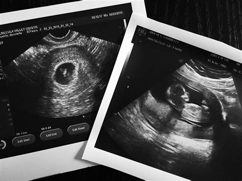 13 Week Ultrasound — The Bump