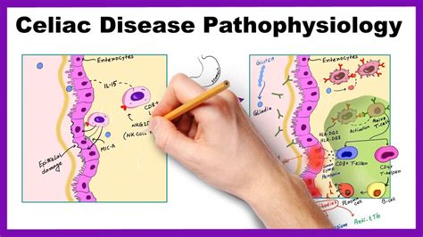 Celiac Disease Pathophysiology Simplified Youtube