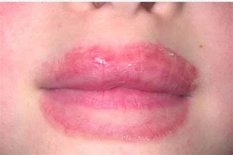 Eczematous Cheilitis What Is It And How Do You Treat It