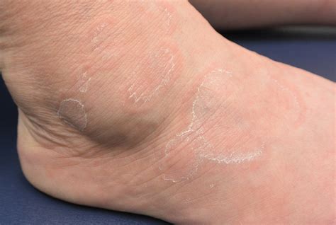 Annular Scaly Plaques Aafp