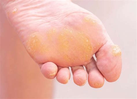 Top Hyperkeratosis Heels Treatment Super Hot Esthdonghoadian