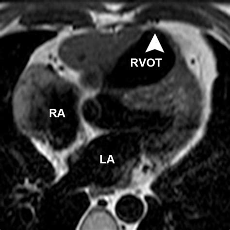 Cardiovascular Mr Imaging After Surgical Correction Of Tetralogy Of