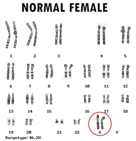 Turner Syndrome Causes Symptoms Life Expectancy Treatment