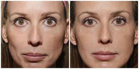 more amazing before and afters of sculptra photos courtesy of dr burke robinson sculptra