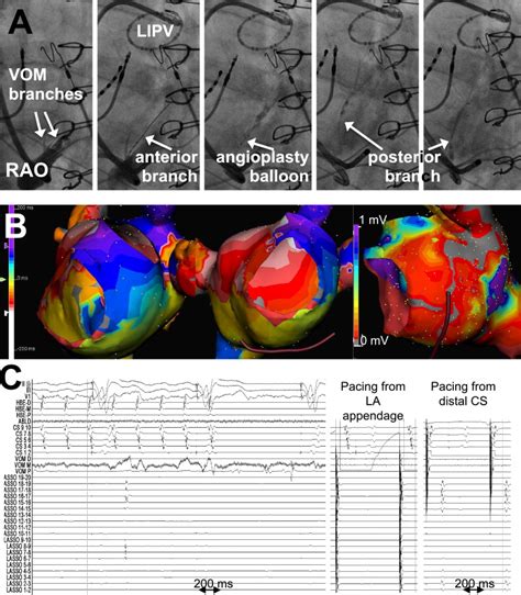 Ethanol Infusion In The Vein Of Marshall Facilitates Mitral Isthmus