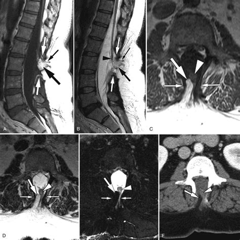 Lipoma Radiology Key