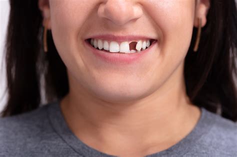5 Effective Ways To Replace A Missing Tooth Magaziano