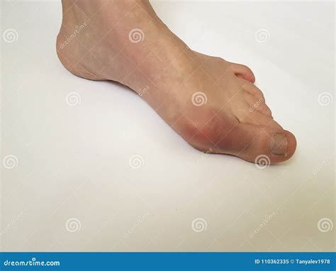 Valgus Deformity Of Legs Royalty Free Stock Image