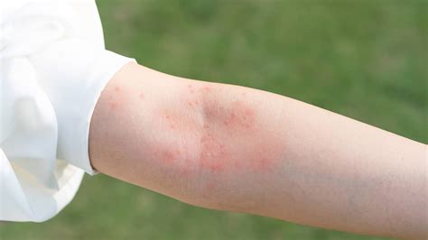 Skin Allergies Symptoms Causes Types Tests And Treatment