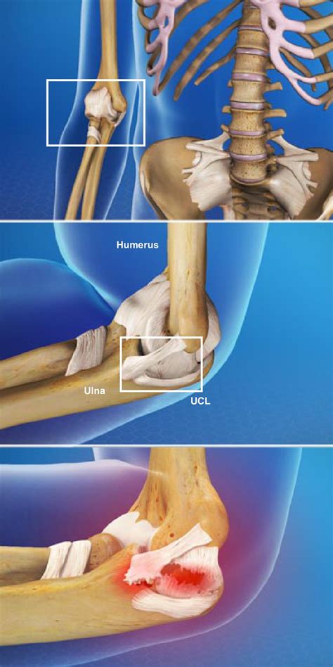 Medial Ulnar Collateral Ligament Injury Orthoriverside Hot Sex Picture