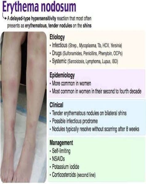 Erythema Nodosum Nurseinfo