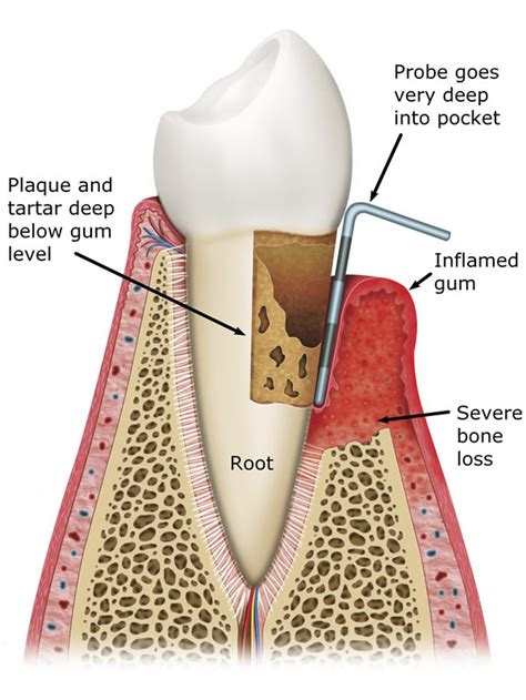 Gum Disease Treatment In Leeds At Street Lane Dental Implant Clinic