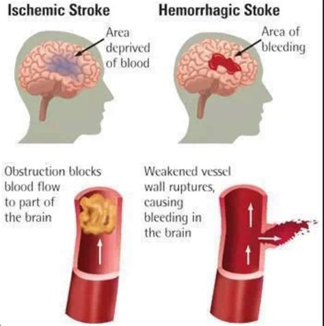 Medical English Medical Informations How To Classify Stroke In The