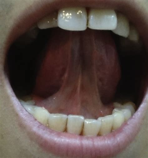 sublingual swelling due to sublingual immunotherapy the journal of allergy and clinical