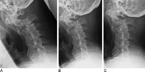 Dynamic Plain Radiographs Of The Cervical Spine In Flexion A Neutral