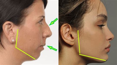 Transform Your Smile With Adult Jaw And Facial Development