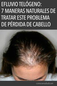 Efluvio Telógeno maneras naturales de tratar este problema de pérdida de cabello