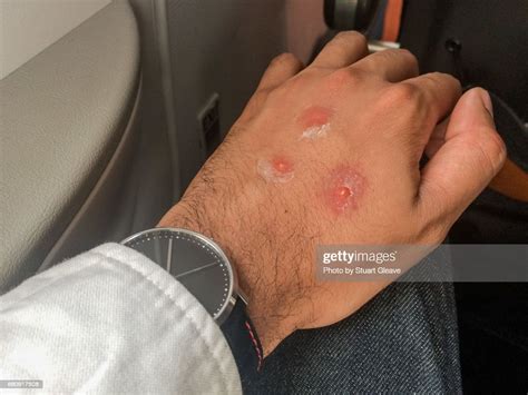 Mosquito Bites On Male Hand High Res Stock Photo Getty Images