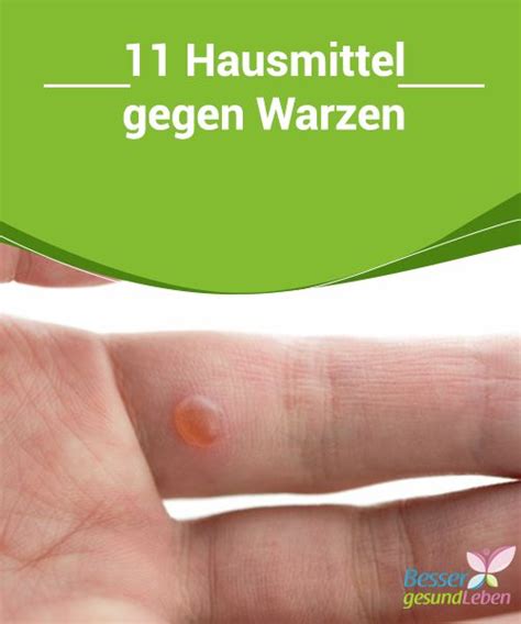 Ohne es zu bemerken, ist man übersät mit mückenstichen. Was tun gegen Warzen? 11 Tipps | Was tun gegen warzen ...