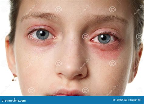 Allergic Reaction Skin Rash Close View Portrait Of A Girl`s Face
