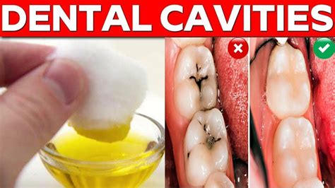 How To Cure Teeth Cavities Naturally At Home Get Rid Of Dental Cavities In Days YouTube