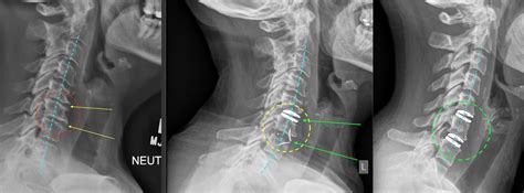 Anterior Cervical Spinal Reconstruction Cutting Edge “hybrids” And