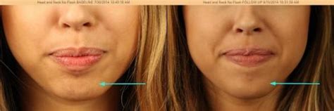 Botox Chin Dana Point Ca Dana Point Dermatology