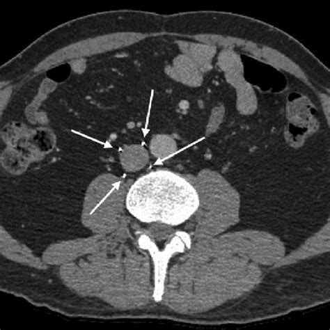 B Single Slice Axial Contrast Enhanced Ct Image Of The Abdomen At The