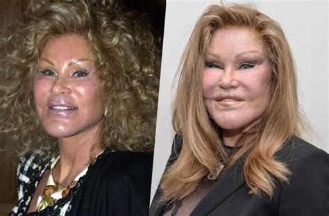 Facelifts Botox Stars With Freaky Faces After Botched Plastic Surgery