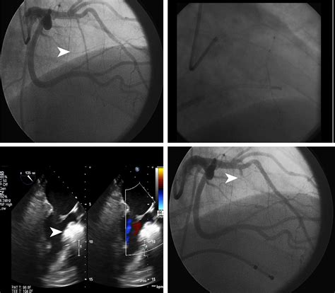 Alcohol Septal Ablation For Obstructive Hypertrophic Cardiomyopathy