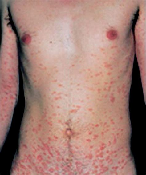 Pityriasis Rosea Fully Evolved Two Weeks After Onset Reprinted With