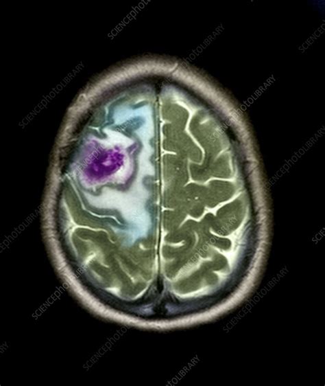Secondary Brain Cancer Mri Scan Stock Image M1340888 Science