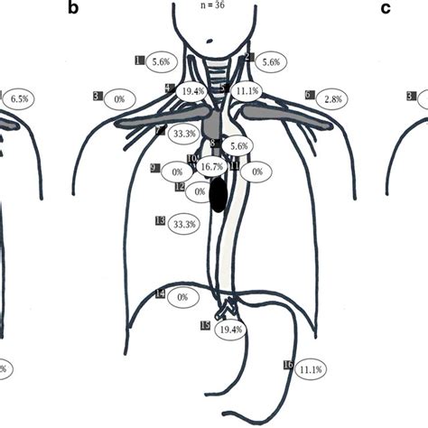 Pattern Of Lymph Node Metastases 1 Right Cervical 2 Left Cervical