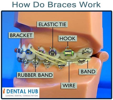How Do Braces Work How Braces Correct Teeth How Braces Move Teeth Movement Of Teeth With