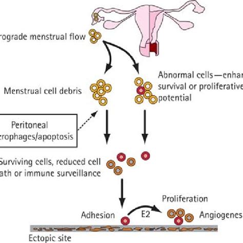 A Theoretical Model Of The Development Of Endometriosis Download Scientific Diagram
